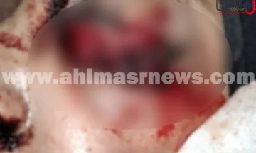 فقدت فيها عينها.. إصابة فتاة في مشاجرة بنجع أبو شجرة بسوهاج